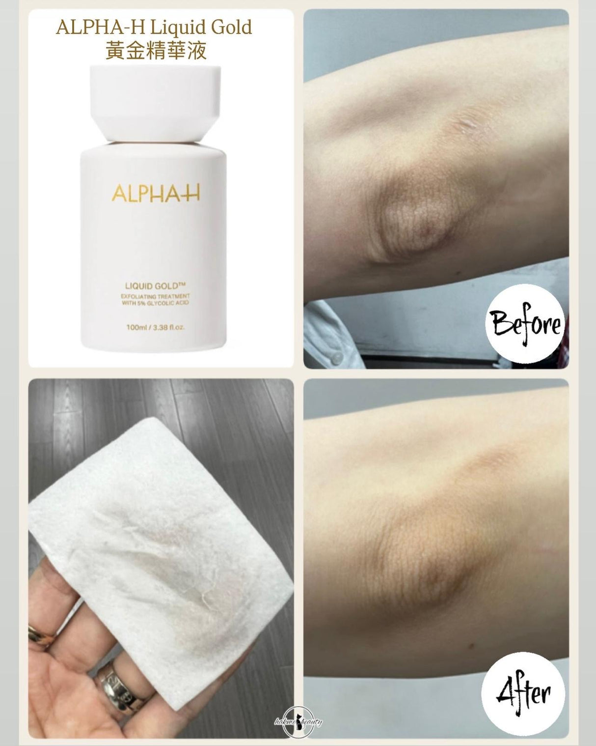 實測 ALPHA-H 黃金精華液用於手肘死角位,有效去除厚重死皮,肌膚回復柔軟平滑,解決身體粗糙問題。