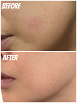 Hakme 實測 Aquafolia SOS Serum 降紅精華 2天極速退紅舒緩對比圖