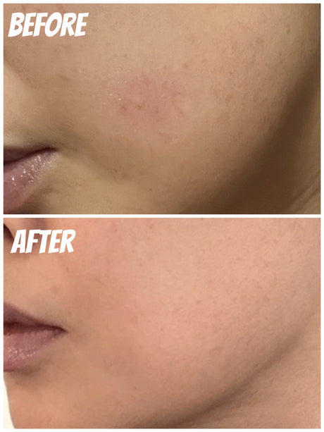 Hakme 實測 Aquafolia SOS Serum 降紅精華 2天極速退紅舒緩對比圖