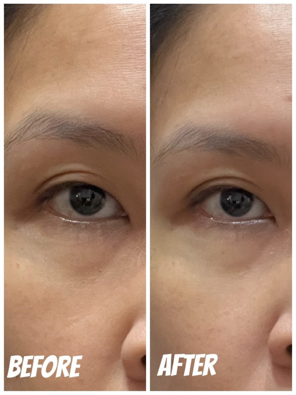 Talika 眼膜使用前後對比：敷後眼底乾紋明顯減淡，眼袋位置變得明亮有光澤，後續化妝不再卡粉起「格仔紋」。