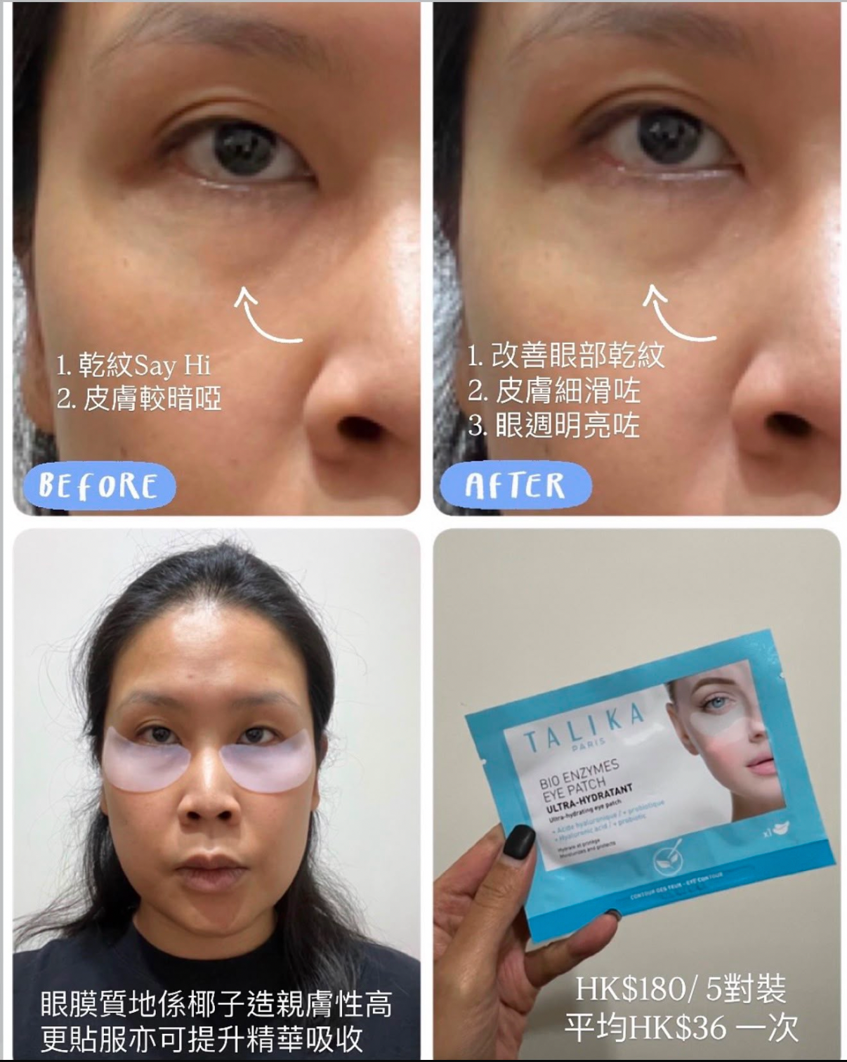 Talika 眼膜使用前後對比：敷後眼底乾紋明顯減淡，眼袋位置變得明亮有光澤，後續化妝不再卡粉起「格仔紋」。