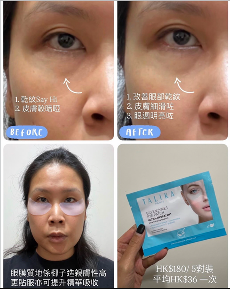 Talika 眼膜使用前後對比：敷後眼底乾紋明顯減淡，眼袋位置變得明亮有光澤，後續化妝不再卡粉起「格仔紋」。