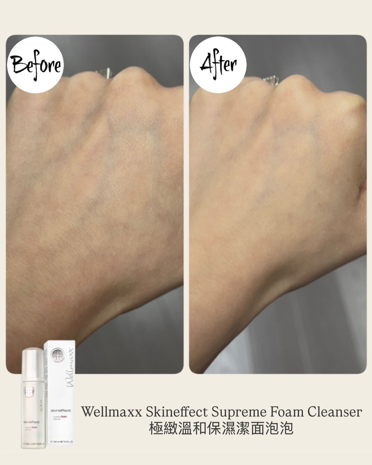 Wellmaxx Skineffect 潔面泡泡使用前後對比：Mr. Honey 實測改善因缺水引致的暗瘡及粒粒，皮膚回復平滑。